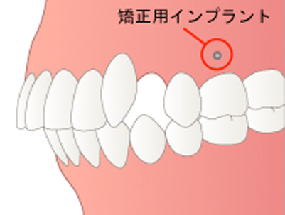 インプラント矯正