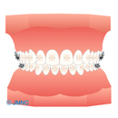 クリアブラケット矯正