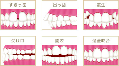 歯並びの種類