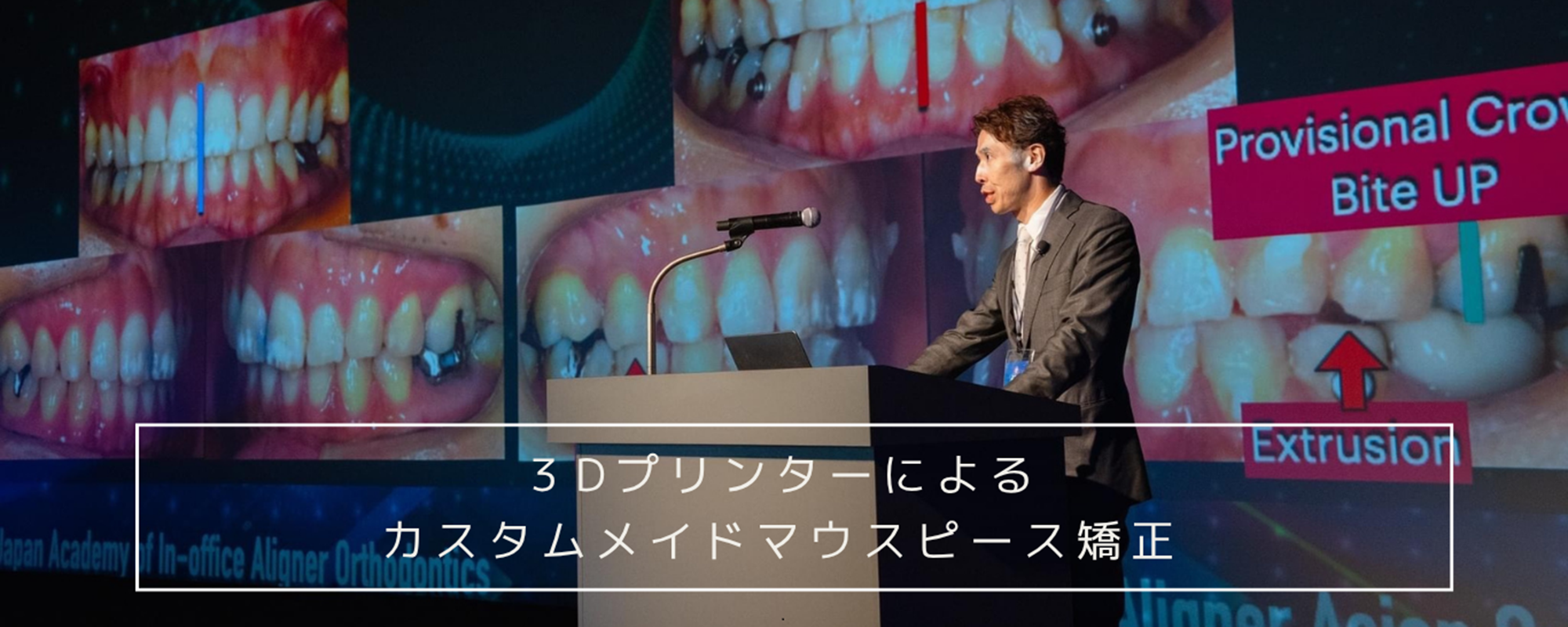 透明で目立ちにくいマウスピース インビザライン invisalign 気づかれにくいマウスピースでストレスフリーの歯列矯正